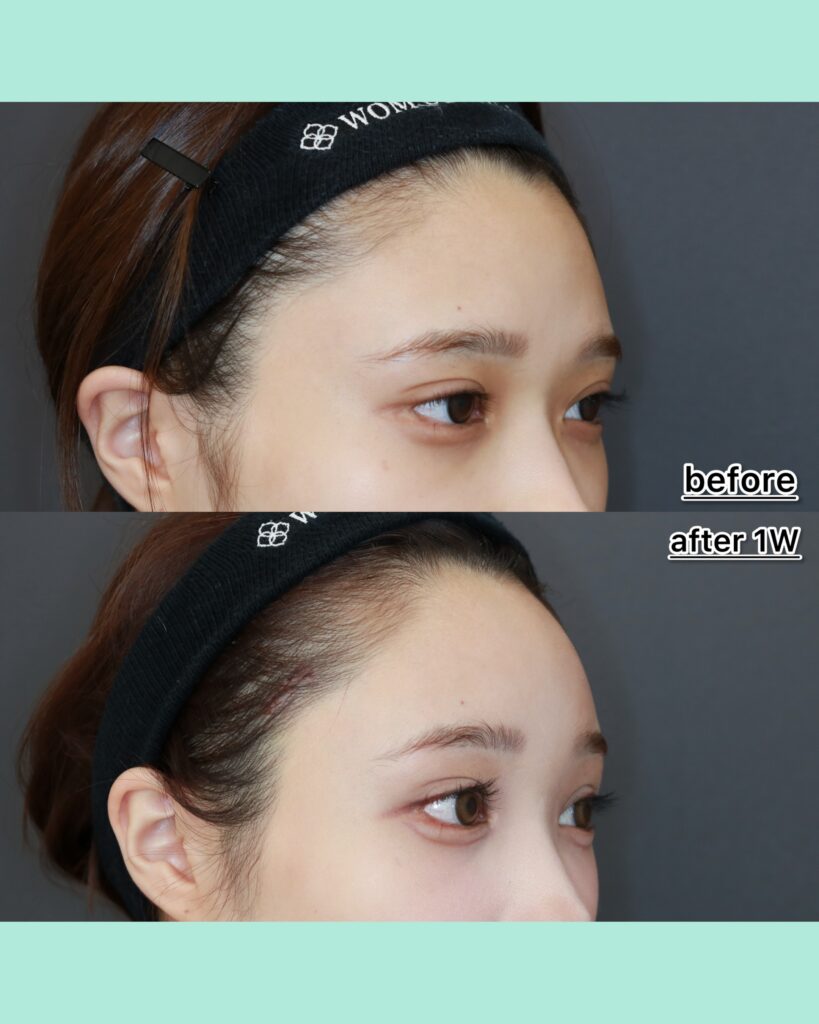 『奥目を解消！内視鏡前額リフト×眉骨削りで叶える明るい目元』の画像