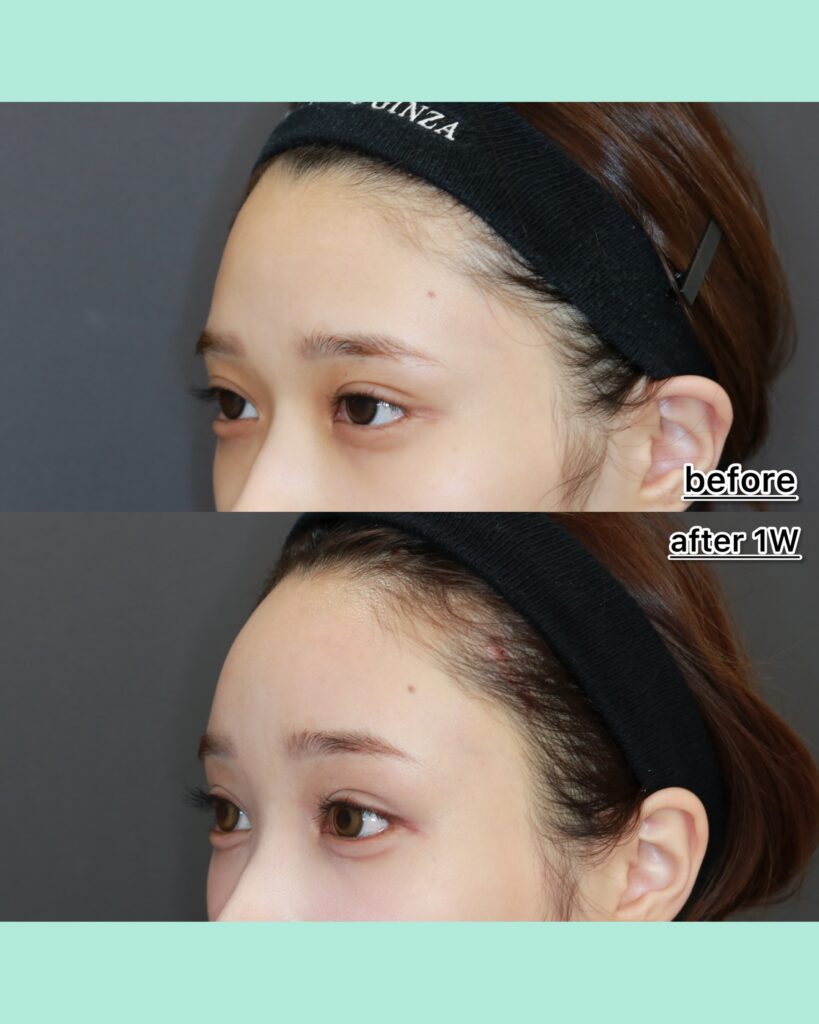 『奥目を解消！内視鏡前額リフト×眉骨削りで叶える明るい目元』の画像