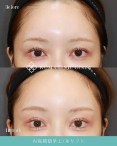 額挙上（前額リフト）の症例02
