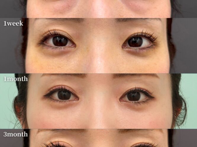 裏ハムラ、涙袋形成