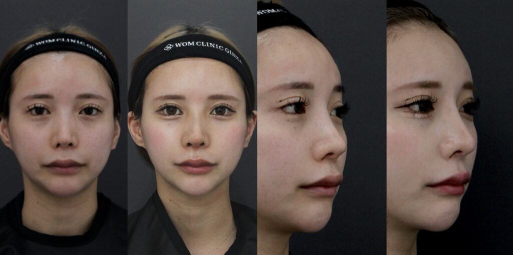 『他院修正:鼻の穴の左右差・曲がり・鼻通りの改善を同時に行った症例』の画像