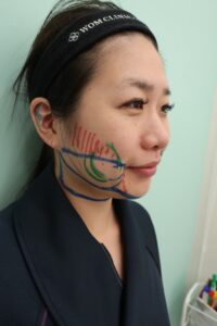 『脂肪吸引で一気に垢抜け！ポイントはマイナー部位への複合アプローチ。』の画像