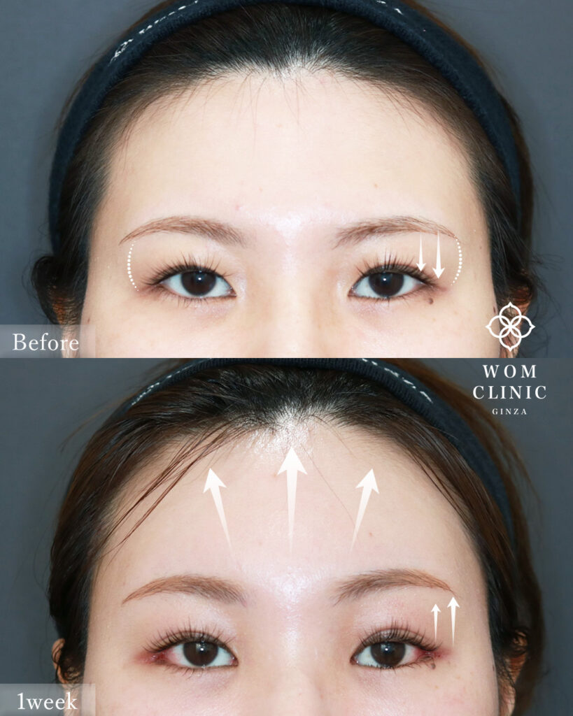 『「奥目」の原因は骨にあり？アイホールボーン削りで目元を明るく』の画像