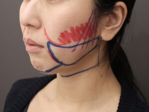 『脂肪吸引でしっかり変化、若々しい卵形輪郭に！』の画像