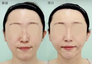 『脂肪吸引で希望の輪郭を実現！ポイントはデザインと吸引の工夫。』の画像