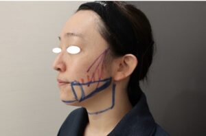 『脂肪吸引で希望の輪郭を実現！ポイントはデザインと吸引の工夫。』の画像