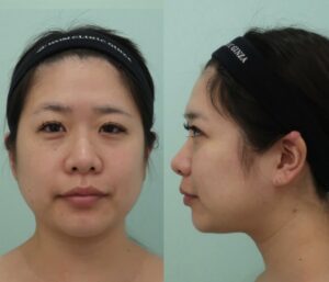 『脂肪吸引で一気に垢抜け！ポイントはマイナー部位への複合アプローチ。』の画像