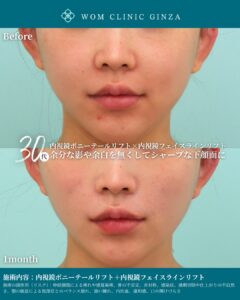 『笑った時の頬肉もスッキリ｜内視鏡ポニーテールリフトで自然に若返る』の画像