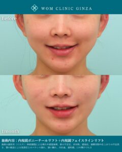 『笑った時の頬肉もスッキリ｜内視鏡ポニーテールリフトで自然に若返る』の画像