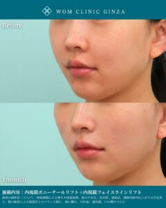 『笑った時の頬肉もスッキリ｜内視鏡ポニーテールリフトで自然に若返る』の画像