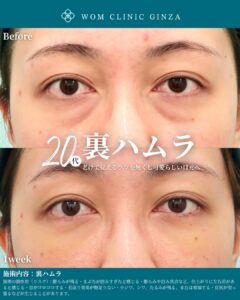 『強い引き込みクマも改善｜裏ハムラで整える自然で明るい目元』の画像