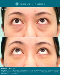 『強い引き込みクマも改善｜裏ハムラで整える自然で明るい目元』の画像