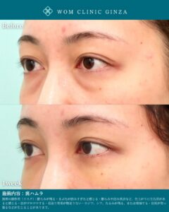 『強い引き込みクマも改善｜裏ハムラで整える自然で明るい目元』の画像