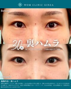 『裏ハムラのみで涙袋の左右差も改善｜クマが原因の非対称を自然に整える』の画像