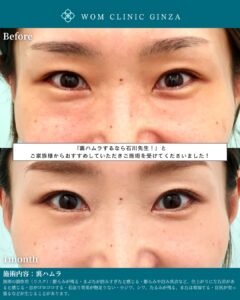 『裏ハムラのみで涙袋の左右差も改善｜クマが原因の非対称を自然に整える』の画像