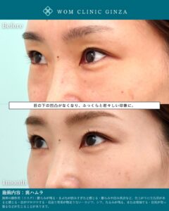 『裏ハムラのみで涙袋の左右差も改善｜クマが原因の非対称を自然に整える』の画像