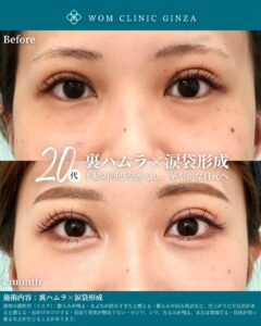 『涙袋形成で睫毛内反気味も改善？｜見た目と機能を両立する目元治療』の画像