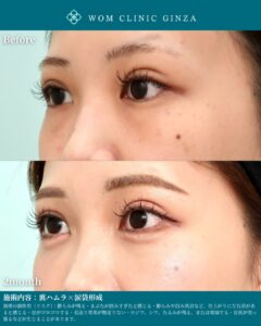 『涙袋形成で睫毛内反気味も改善？｜見た目と機能を両立する目元治療』の画像