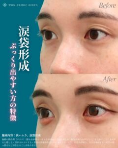 『涙袋形成でぷっくり出やすい人とは？解剖学から考える理想の目元作り』の画像