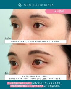 『涙袋形成でぷっくり出やすい人とは？解剖学から考える理想の目元作り』の画像