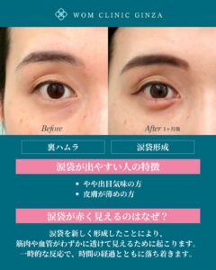 『涙袋形成でぷっくり出やすい人とは？解剖学から考える理想の目元作り』の画像