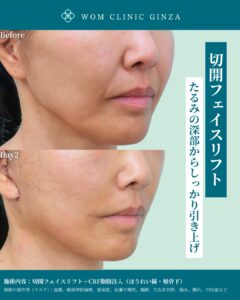 『内視鏡フェイスリフトを極める鍵はEXTENDED DEEP PLANE FACELIFTの理解』の画像