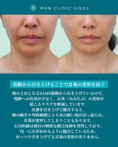 『内視鏡フェイスリフトを極める鍵はEXTENDED DEEP PLANE FACELIFTの理解』の画像