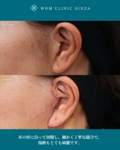 『内視鏡フェイスリフトを極める鍵はEXTENDED DEEP PLANE FACELIFTの理解』の画像