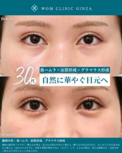 『涙袋で目を大きく魅せる方法｜グラマラスライン併用で自然な華やかさを』の画像