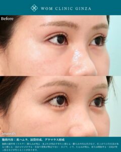 『涙袋で目を大きく魅せる方法｜グラマラスライン併用で自然な華やかさを』の画像