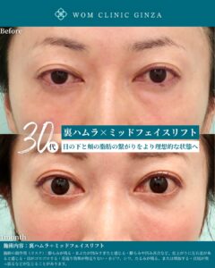 『裏ハムラ×ミッドフェイスリフトで美しいOGカーブを再構築する方法』の画像