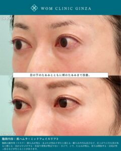 『裏ハムラ×ミッドフェイスリフトで美しいOGカーブを再構築する方法』の画像