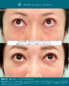 『裏ハムラ×ミッドフェイスリフトで美しいOGカーブを再構築する方法』の画像