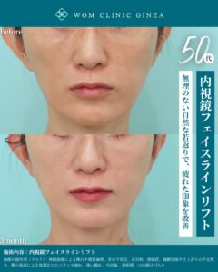 『切開フェイスリフト後修正×内視鏡フェイスラインリフト|超難症例への挑戦』の画像