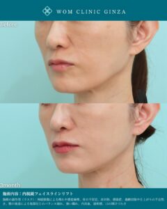 『切開フェイスリフト後修正×内視鏡フェイスラインリフト|超難症例への挑戦』の画像