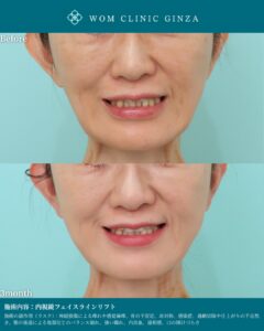 『切開フェイスリフト後修正×内視鏡フェイスラインリフト|超難症例への挑戦』の画像