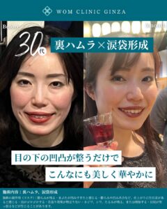 『裏ハムラ+涙袋形成でさらに魅力的に|3ヶ月経過で分かる自然な若返り』の画像