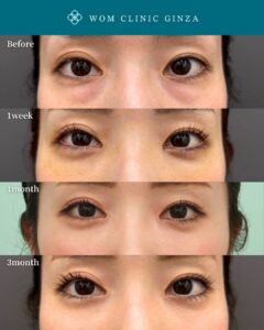 『裏ハムラ+涙袋形成でさらに魅力的に|3ヶ月経過で分かる自然な若返り』の画像