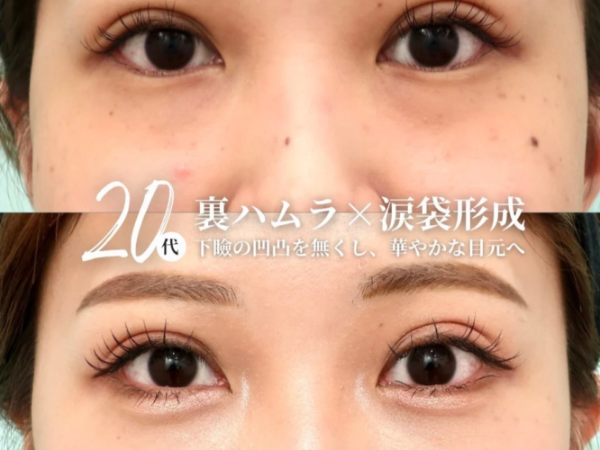 裏ハムラ　涙袋形成