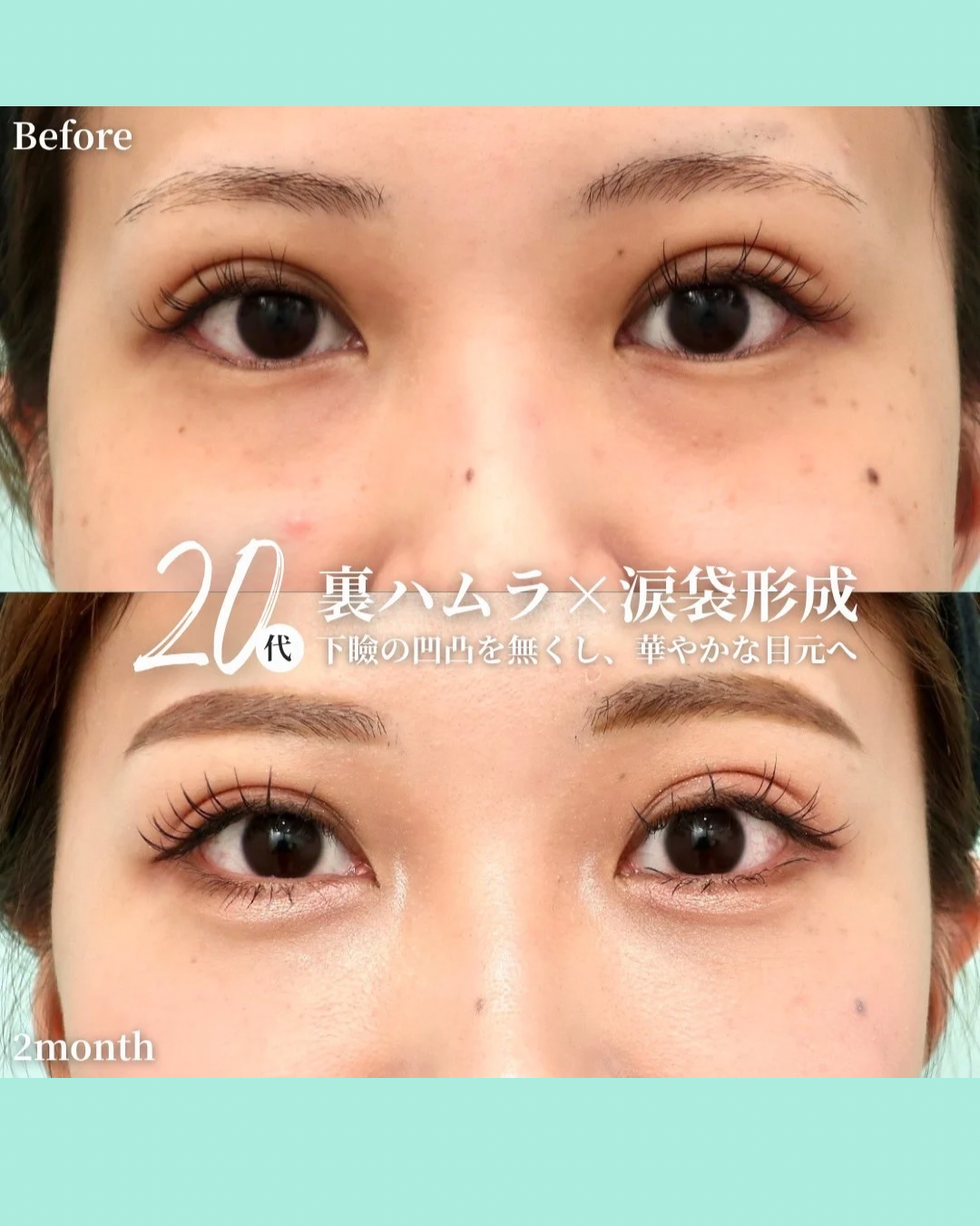 裏ハムラ　涙袋形成