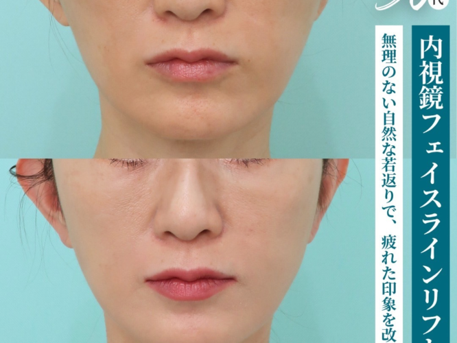 フェイスラインリフト
