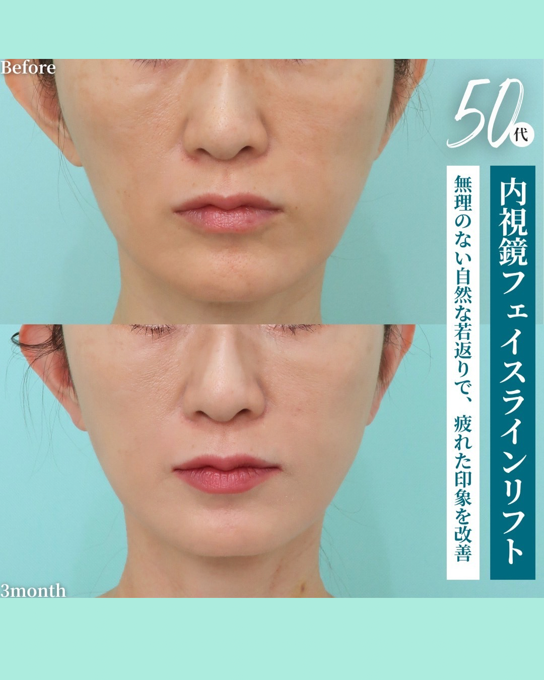 フェイスラインリフト