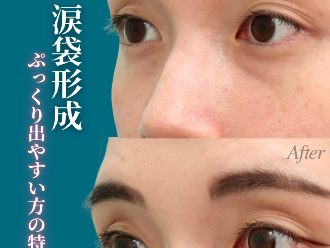 裏ハムラ、涙袋形成