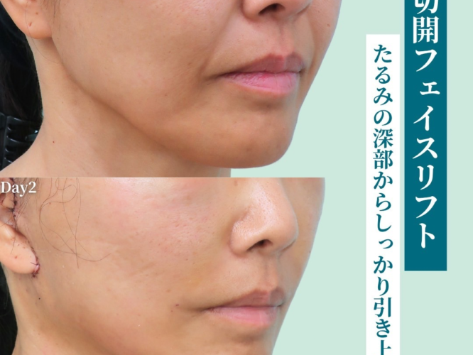 切開フェイスリフト
