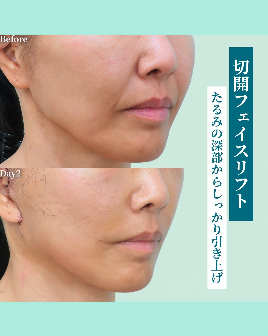 切開フェイスリフト