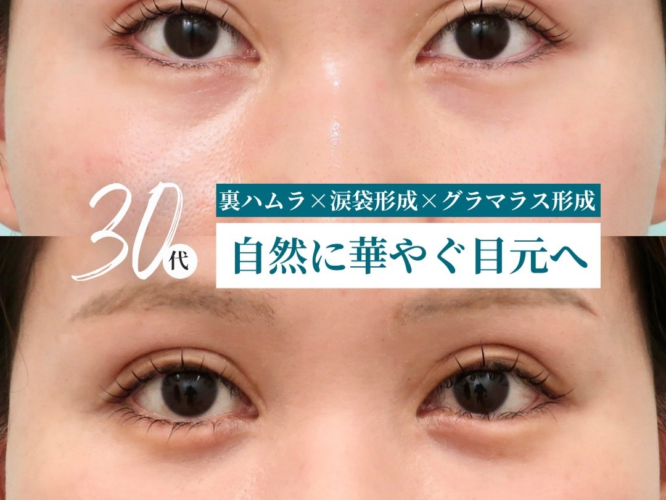 裏ハムラ、涙袋形成、グラマラス形成