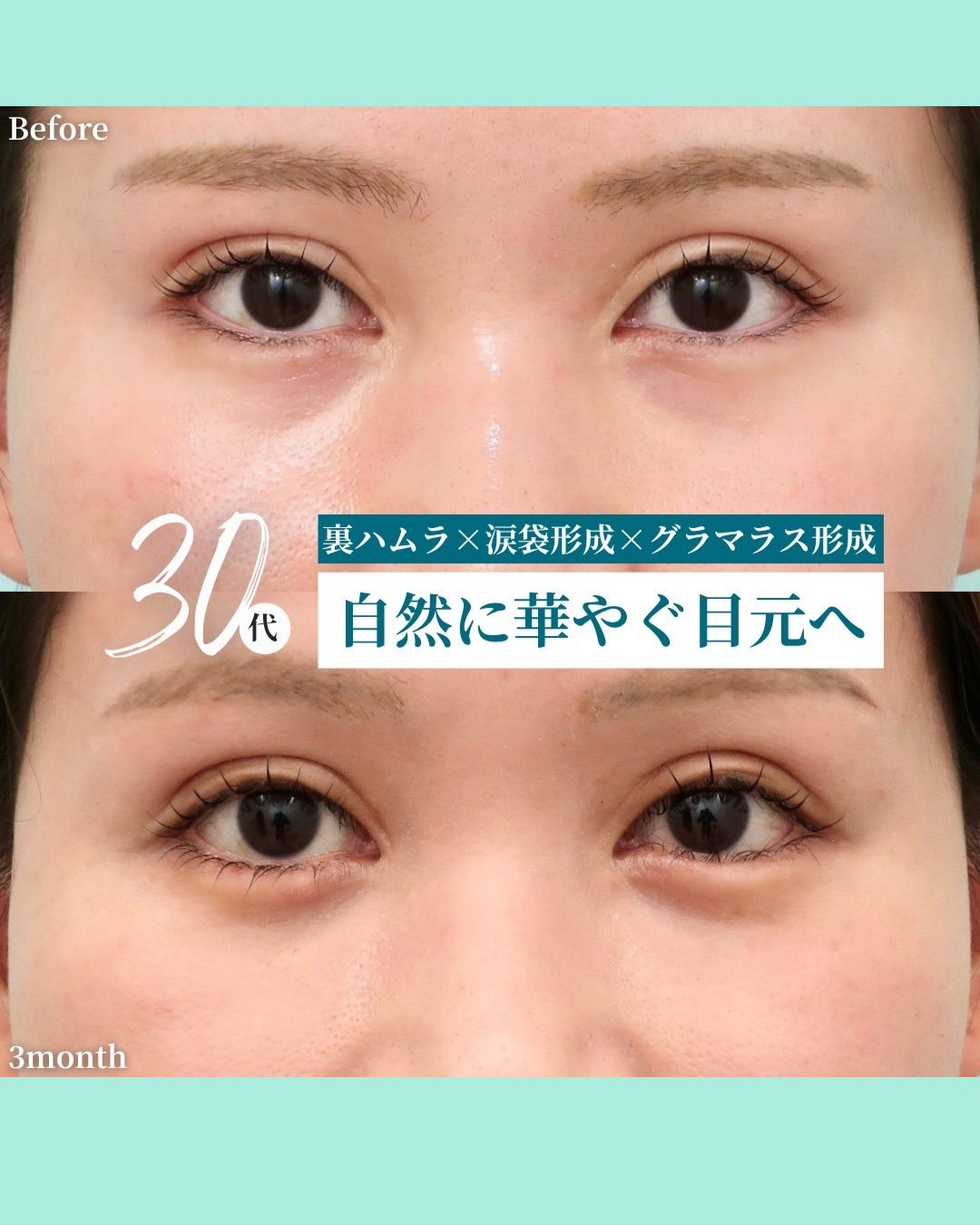 裏ハムラ、涙袋形成、グラマラス形成