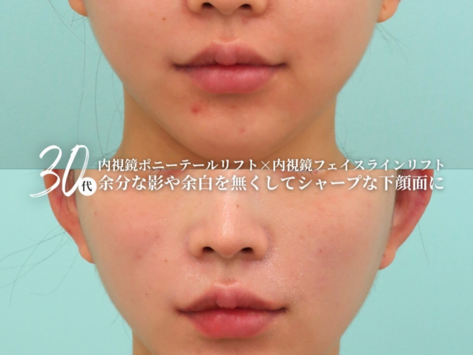 ポニーテールリフト