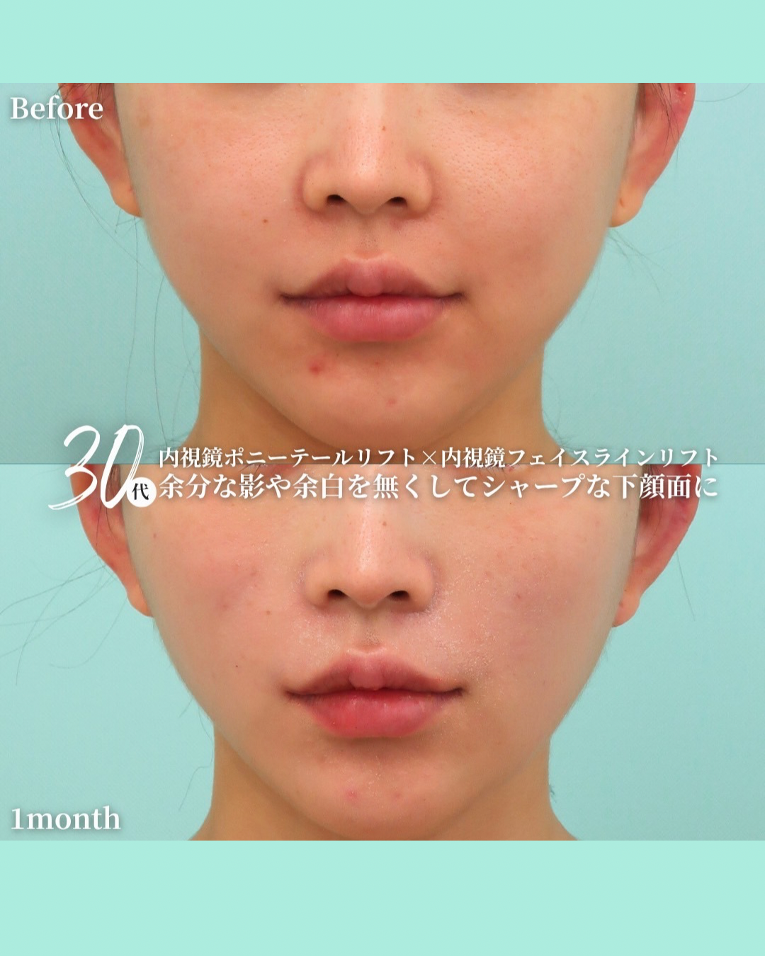 ポニーテールリフト