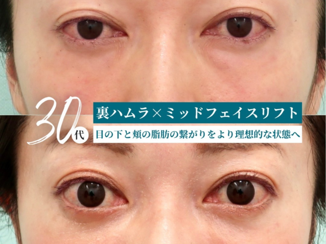 裏ハムラ　ミッドフェイスリフト